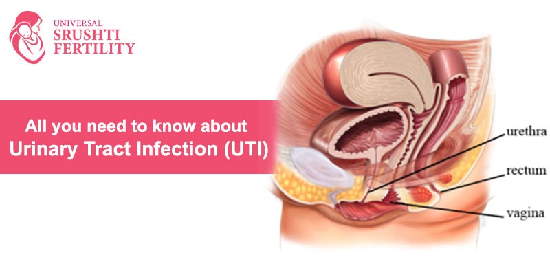 What causes UTI?